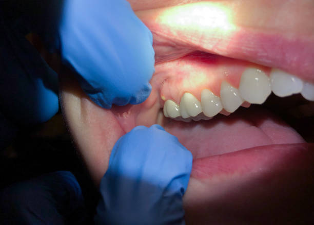 Best Emergency Dental Care for Abscessed Tooth in Grandview, MO