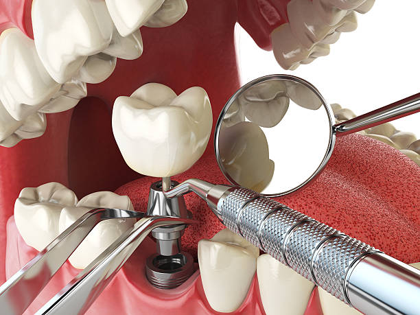 Best Emergency Root Canal Treatment in Grandview, MO